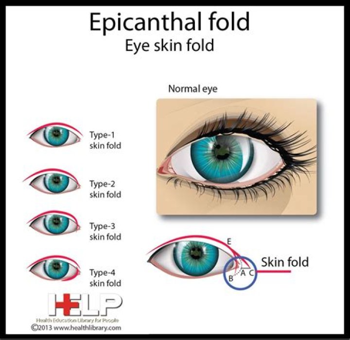 Are epicanthal folds normal?