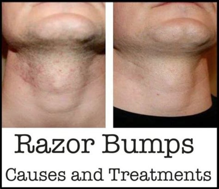 Do you get razor bumps from waxing?