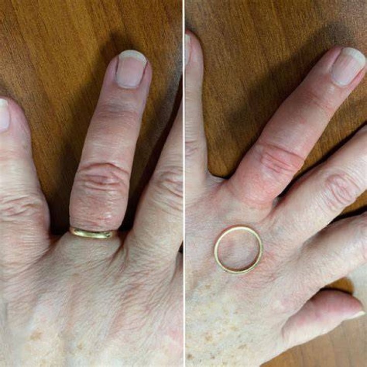 Where to go to cut ring off finger?